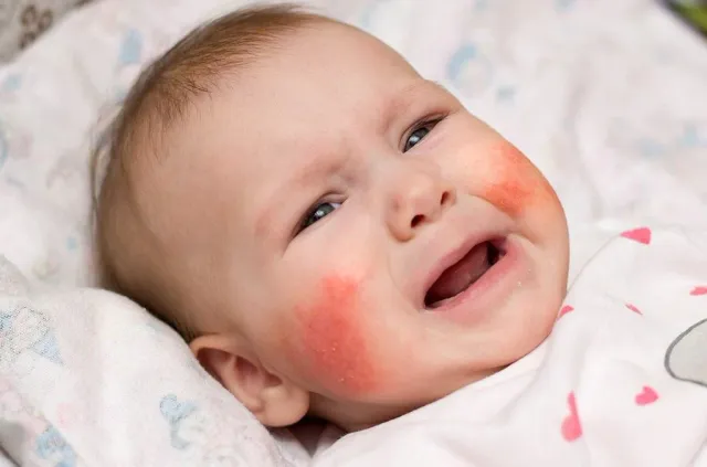 Cách nhận biết và chăm sóc trẻ sơ sinh bị viêm da cơ địa