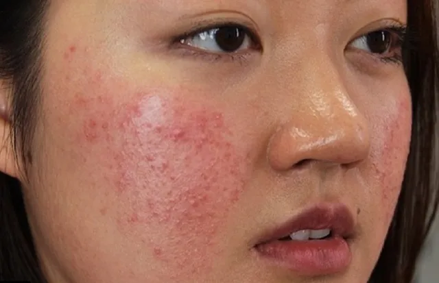 Bí quyết chăm sóc da cho người bị viêm da dị ứng