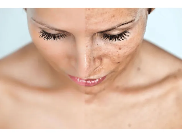 Nguyên Nhân Gây Nám Da Mà Người Việt Nam Thường Gặp