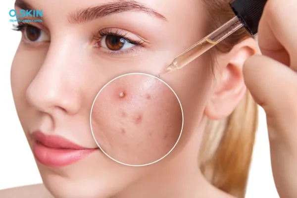 5 bước chăm sóc da mụn trứng cá chuẩn y khoa tại nhà