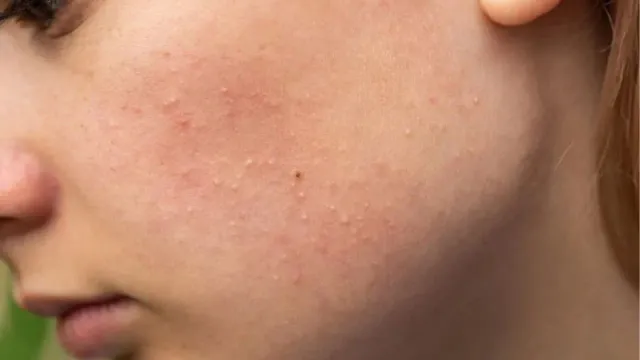 Phác đồ và cách chăm sóc điều trị mụn ẩn chuẩn y khoa