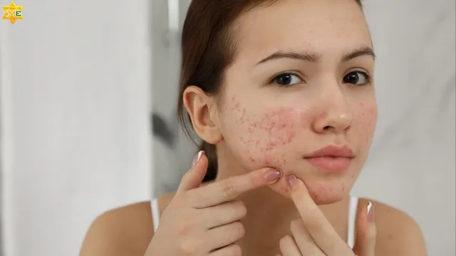 10 cách chăm sóc da mụn tại nhà an toàn và hiệu quả