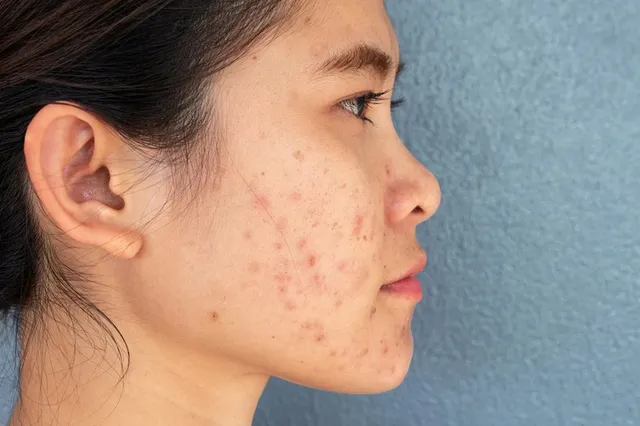 Da mụn là gì? Cách chăm sóc da mụn tại nhà đúng cách