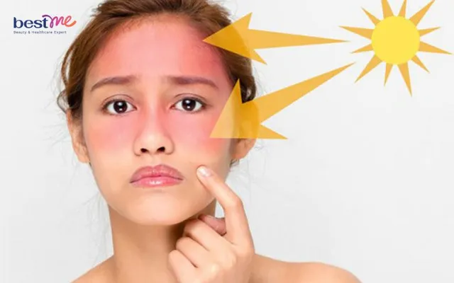 Quy trình chăm sóc da mùa hè kiềm dầu và ngăn ngừa mụn