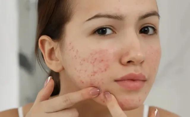 Cách chăm sóc da mụn hiệu quả: quy trình cho người mới