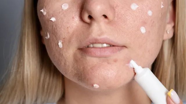 Chăm sóc da mụn đúng cách: Quy trình và lưu ý cần biết
