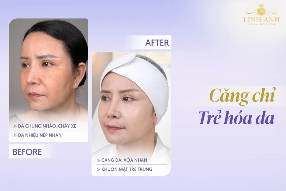 Hình ảnh quy trình điều trị trẻ hóa da tại Phòng khám Linh Anh (ảnh 4)