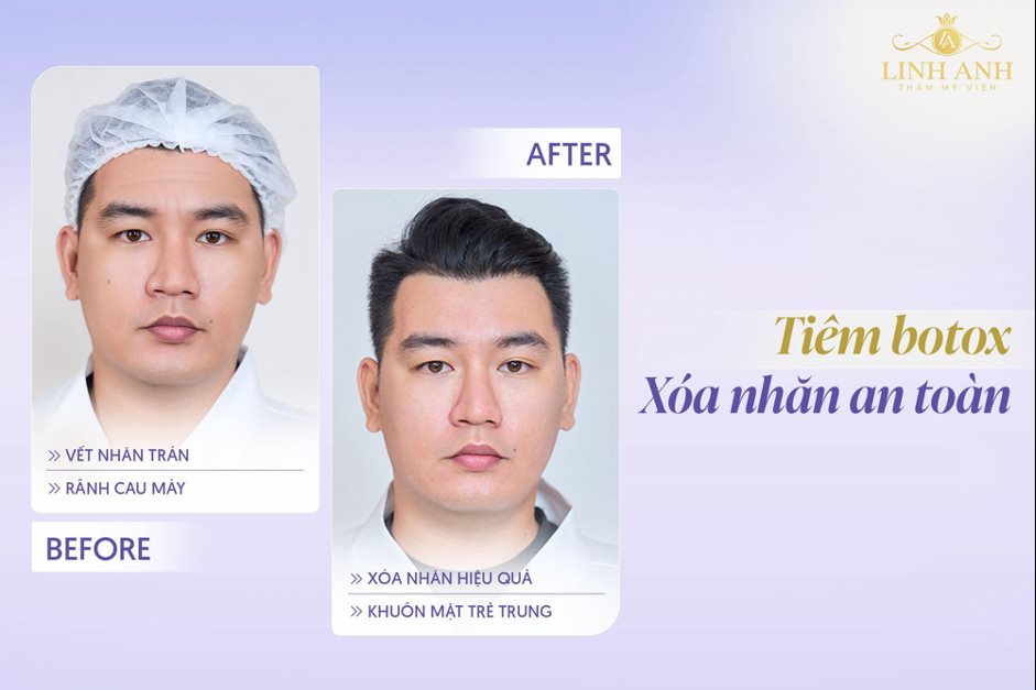 Hình ảnh quy trình điều trị trẻ hóa da tại Phòng khám Linh Anh (ảnh 3)