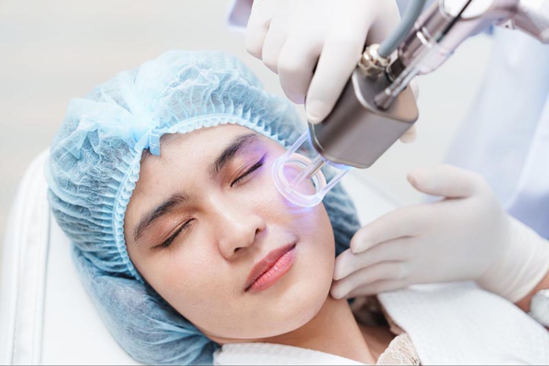 Bắn laser trị nám sau sinh hiệu quả