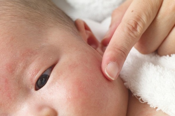 Mẹ ôm bé da kề da