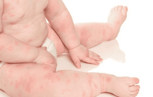 Mề đay ở trẻ sơ sinh: Nguyên nhân và một số triệu chứng