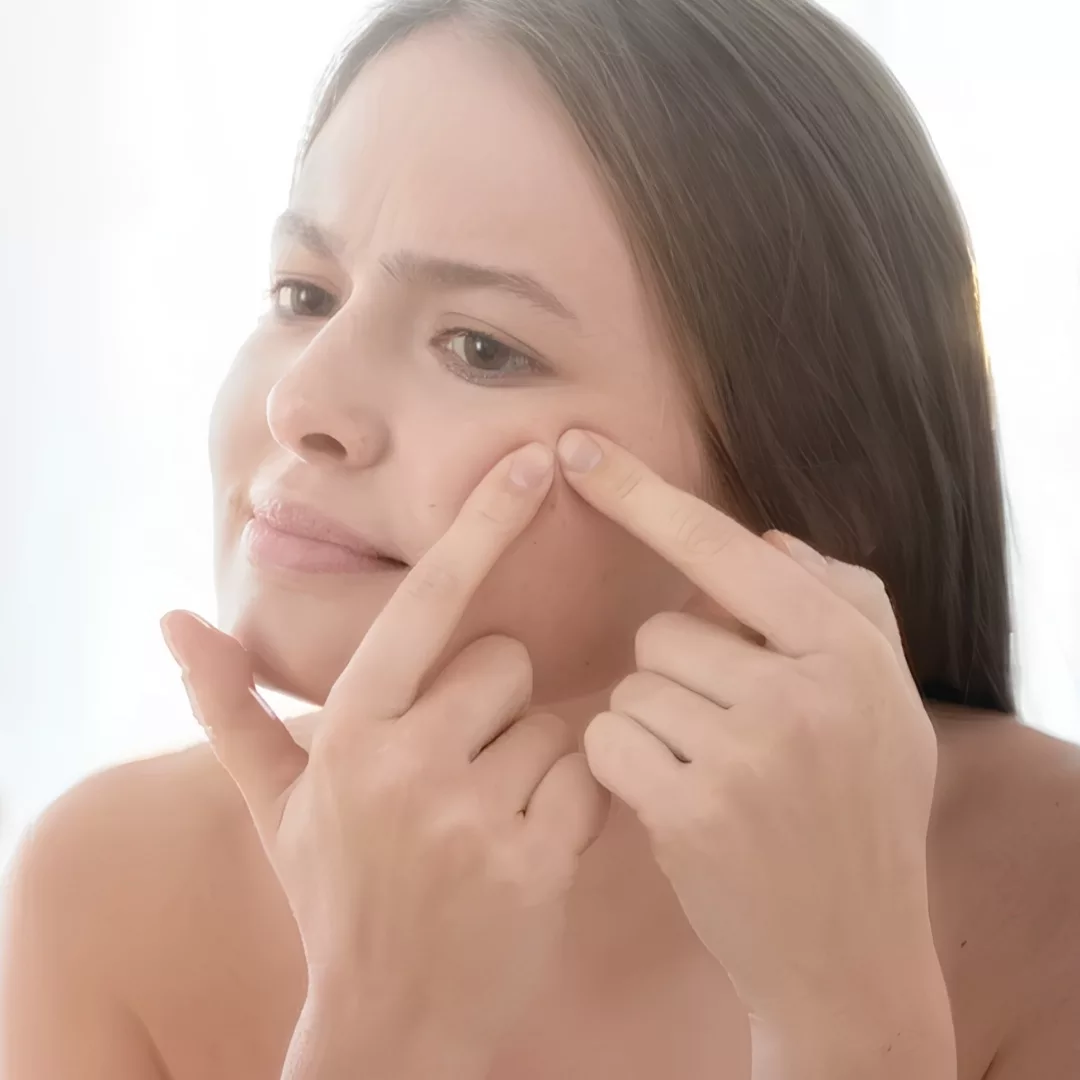 Nặn mụn nhọt tại nhà