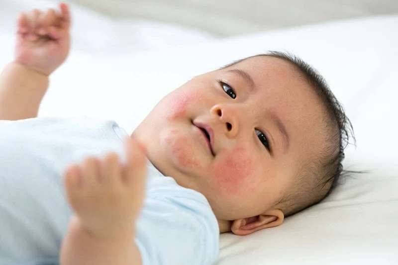 Trẻ sơ sinh bị nổi mẩn đỏ: Nguyên nhân và cách mẹ chăm sóc bé đúng cách