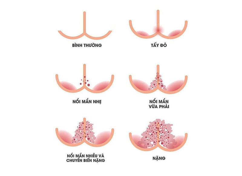 Các mức độ tổn thương hăm da ở trẻ nhỏ