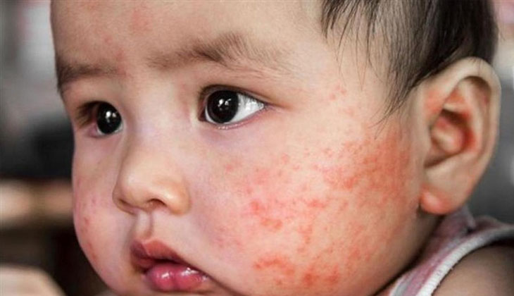 Trẻ sơ sinh nổi mẩn đỏ