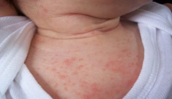 Da em bé sơ sinh bị mẩn đỏ