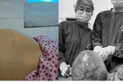 Bụng to bất thường, người phụ nữ Hà Nội bất ngờ với khối u xơ tử cung 6kg
