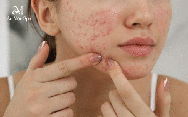 Nguyên nhân phổ biến và đặc điểm của làn da mụn