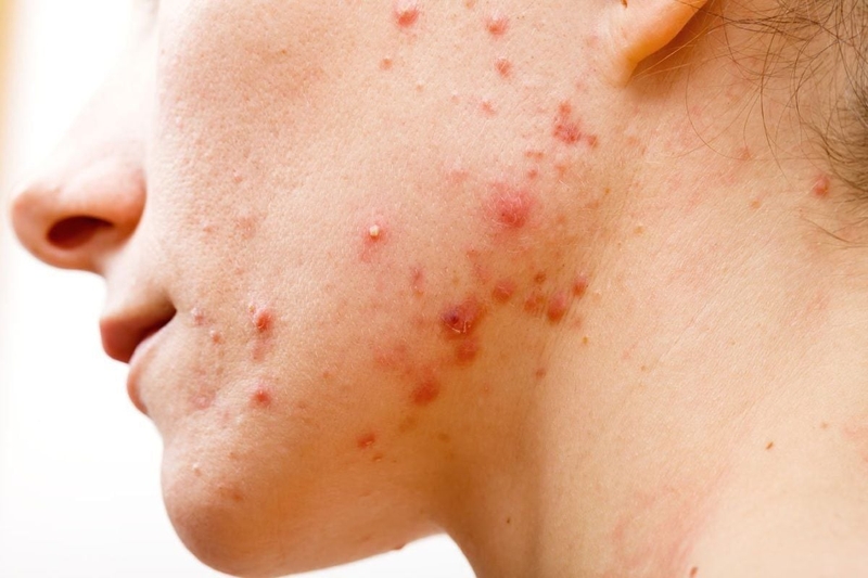 Chăm sóc da khô mụn đòi hỏi sự cân bằng ẩm kỹ lưỡng