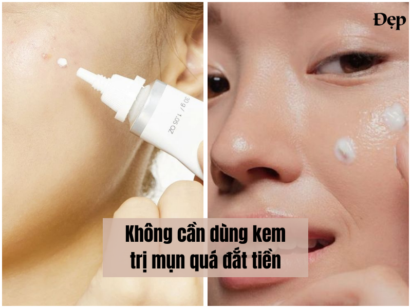 Không cần dùng kem trị mụn quá đắt tiền