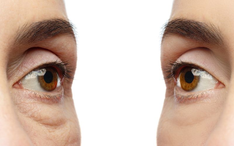 Dấu hiệu lão hóa quanh mắt
