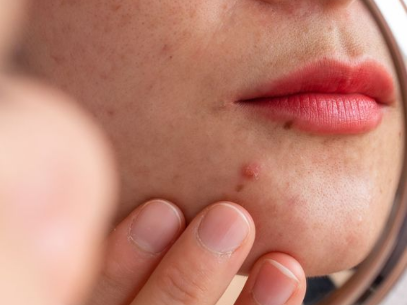Da mụn có đặc điểm gì