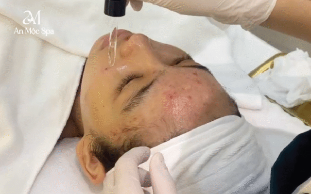 Gợi ý sản phẩm chăm sóc da mụn nên dùng