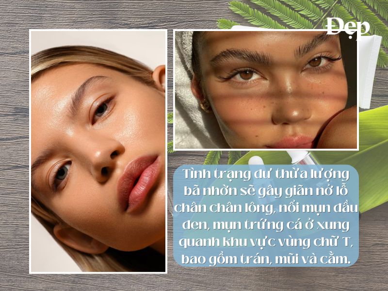 Da dầu và lỗ chân lông giãn nở