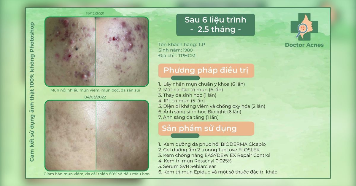 ca lâm sàng điều trị mụn thành công tại DA