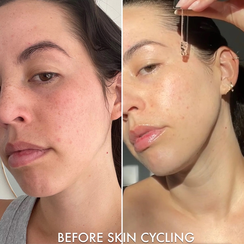 Skin cycling cần được điều chỉnh theo độ nhạy cảm, mức tiết dầu và tình trạng mụn của từng làn da