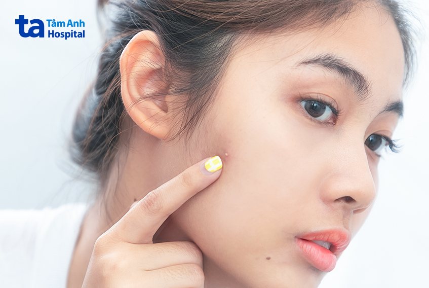 Xây dựng chế độ ăn uống lành mạnh và lối sống điều độ sẽ ngăn mụn ẩn xuất hiện