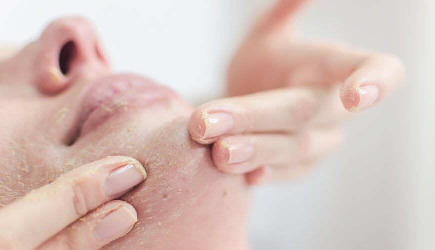 tẩy tế bào chết cho da mụn