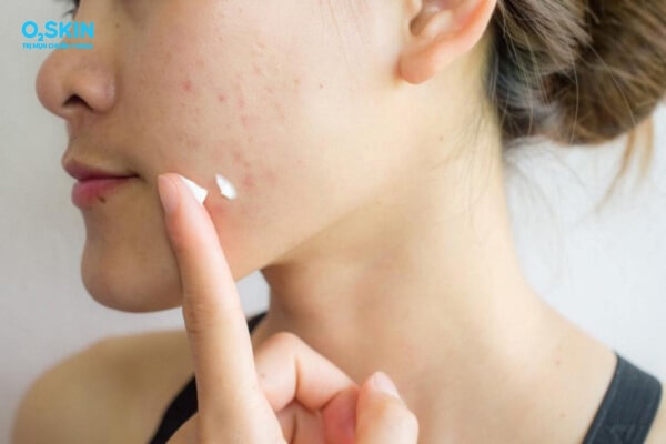 Sản phẩm điều trị mụn cần được lựa chọn phù hợp với tình trạng da