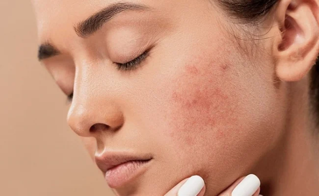 Da mụn được phân thành các loại khác nhau: Mụn viêm và mụn không viêm (Nguồn: Sưu tầm)