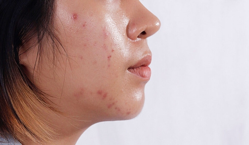 Gợi ý trọn bộ skincare cho da dầu mụn 1