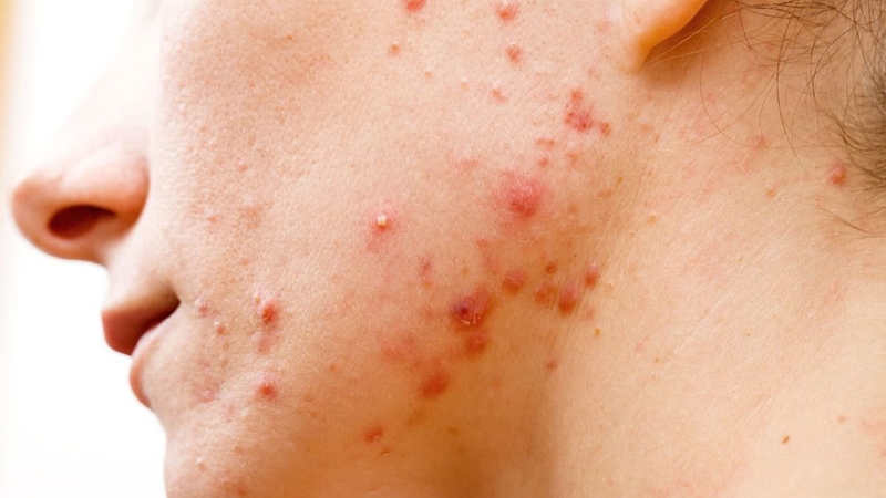 Quy trình skincare ngày và đêm cho da mụn, da dầu 1