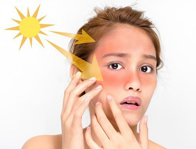 Tầm quan trọng của việc bôi kem chống nắng bảo vệ da mụn