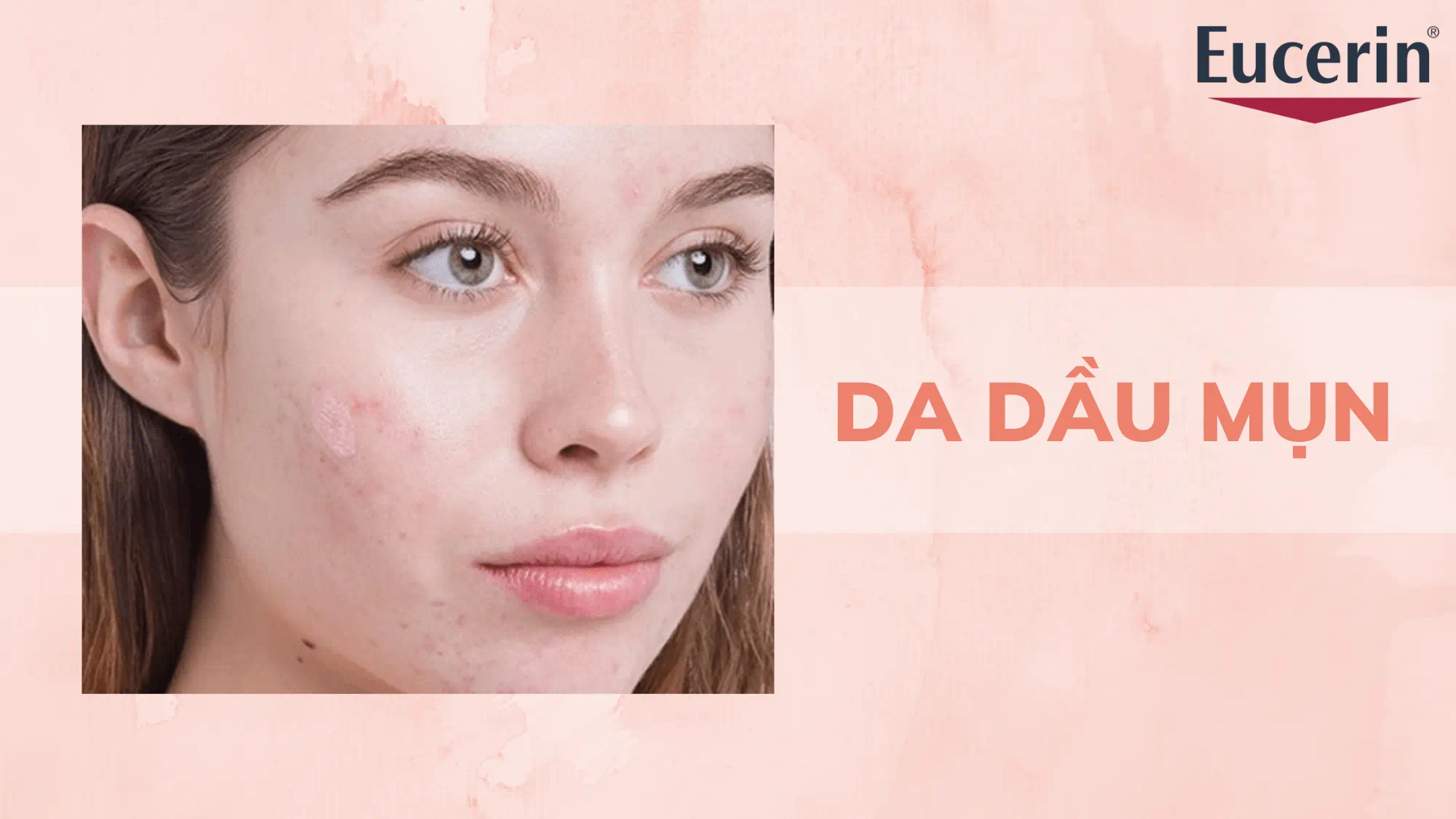 Da dầu mụn là tình trạng tiết bã nhờn nhiều kèm bít tắc lỗ chân lông và viêm mụn