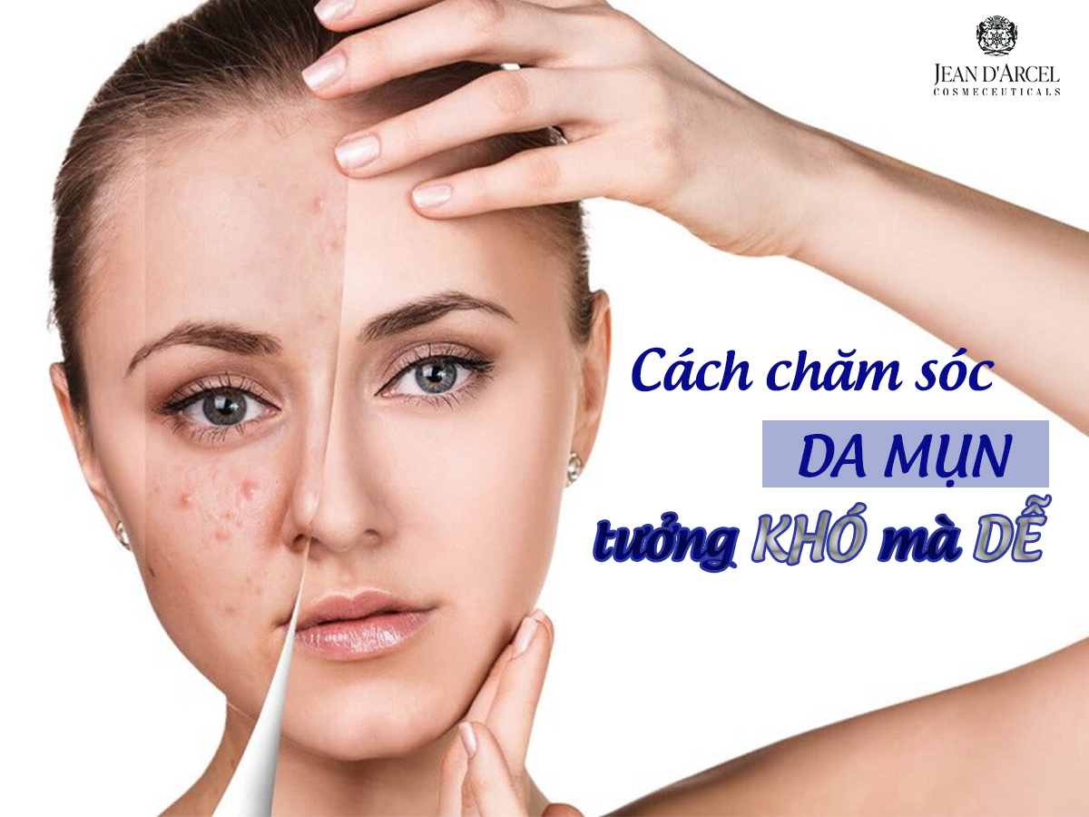 Sai lầm trong chăm sóc da mụn