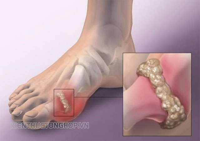 Hình ảnh tinh thể urat sắc nhọn dưới lăng kính hiển vi