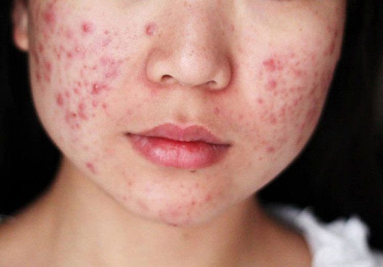 Da mụn viêm đỏ và sưng