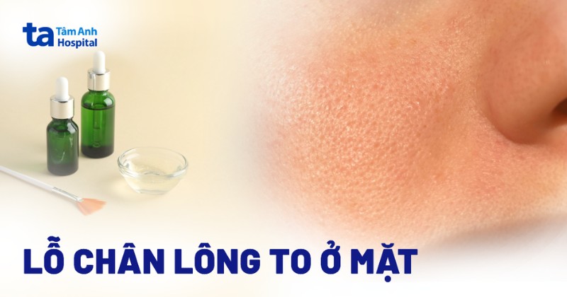 Lỗ chân lông to ở vùng mặt - hướng dẫn khắc phục từ bác sĩ da liễu Tâm Anh